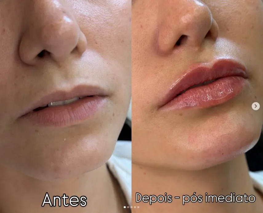 Comparativo de lábios antes e imediatamente após o preenchimento labial